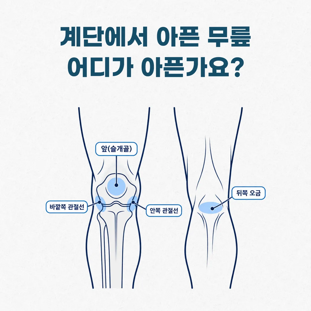 무릎 통증 부위를 앞·안쪽·바깥쪽·오금 네 구역으로 나눈 개념도