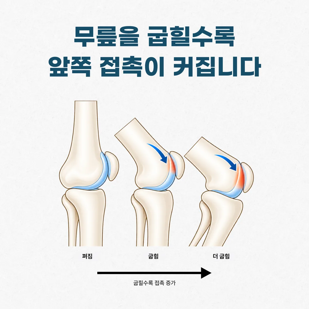 무릎을 굽힐 때 슬개골이 움직이는 경로를 표시한 관절 측면 개념도