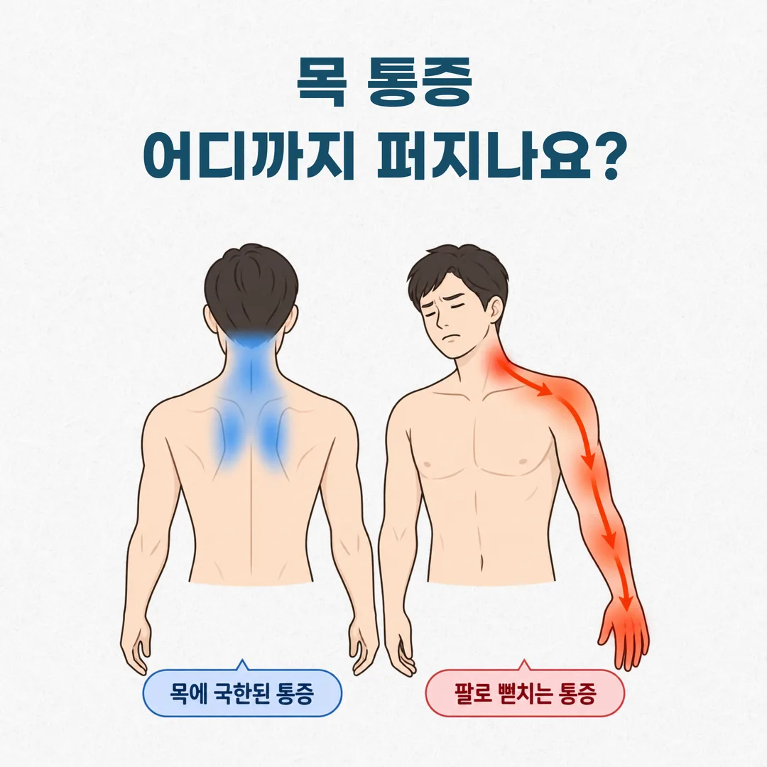목에 국한된 통증 범위와 팔로 뻗치는 방사통 범위를 구분해 표시한 도해